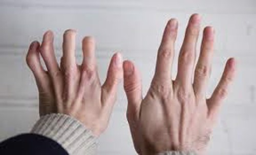 Bị viêm đa khớp dạng thấp nên điều trị như thế nào? PGS. TS Dương Trọng Hiếu tư vấn