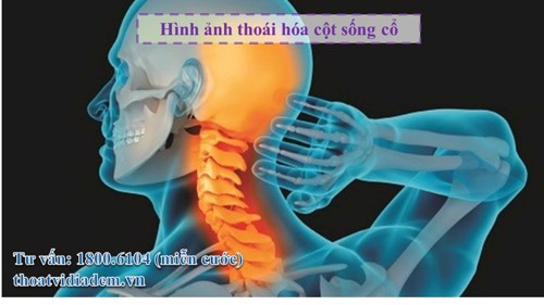 Tổng hợp các thông tin quan trọng về bệnh thoái hóa cột sống cổ 