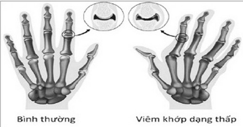 Có thể phát hiện sớm bệnh viêm khớp dạng thấp được không? PGS. TS Dương Trọng Hiếu giải đáp