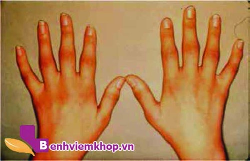 3 bài thuốc dân gian chữa viêm khớp dạng thấp hiệu quả tại nhà