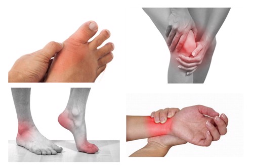 Bị sưng khớp ở nhiều vị trí khác nhau là dấu hiệu của bệnh gì? PGS. TS Dương Trọng Hiếu giải đáp