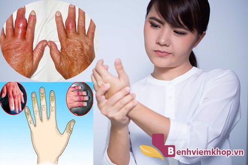  Bệnh viêm khớp dạng thấp có chữa khỏi không? – Xem ngay để biết!