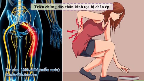 Triệu chứng tố cáo bạn đã bị chèn ép dây thần kinh tọa 