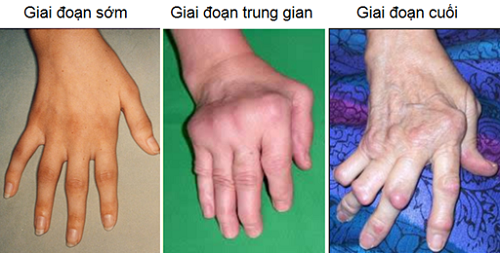 Viêm khớp dạng thấp có thể gây ra những biến chứng gì? Nên điều trị bệnh như thế nào?