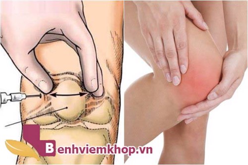 Viêm khớp gối có dịch là gì? Nguyên nhân và biện pháp khắc phục