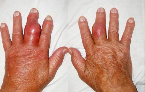 Bệnh viêm khớp dạng thấp có chữa được không? Chuyên gia Nguyễn Thị Lực tư vấn