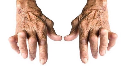 Bị viêm khớp dạng thấp và có tiền sử đau dạ dày, liệu dùng Hoàng Thấp Linh được không?