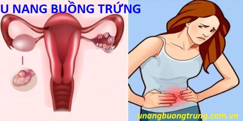 TẠI SAO NGA PHỤ KHANG ĐƯỢC TIN DÙNG TRONG HỖ TRỢ ĐIỀU TRỊ U NANG BUỒNG TRỨNG?