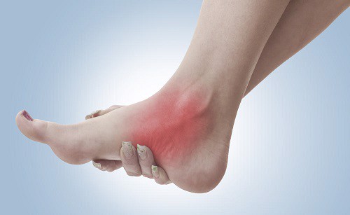 Bệnh viêm khớp dạng thấp có gây đau khớp bàn chân không? Chuyên gia Nguyễn Thị Lực tư vấn