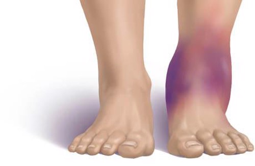 Bị đau ở khớp cổ chân, kèm sưng nóng có phải dấu hiệu của viêm khớp không?