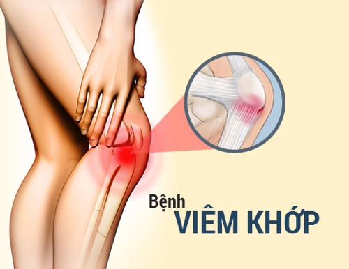 Viêm khớp gối là bệnh như thế nào và triệu chứng để nhận biết bệnh là gì?