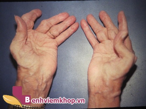 Phương pháp điều trị viêm khớp dạng thấp thực hiện như thế nào? Hoàng Thấp Linh giúp cải thiện các triệu chứng bệnh ra sao?