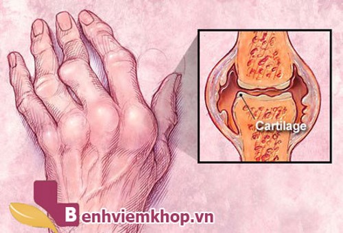 Người mắc bệnh viêm khớp nên ăn gì để nhanh chóng hồi phục vận động?