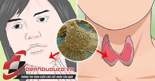 Các triệu chứng của bệnh u tuyến giáp thường bị bỏ qua và biện pháp khắc phục