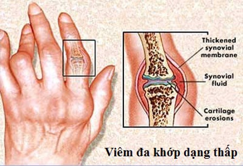 Viêm khớp dạng thấp có di truyền không? Dùng Hoàng Thấp Linh hỗ trợ điều trị lâu dài được không?