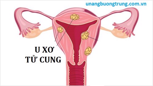 HỌC NGAY: Cách cải thiện U XƠ TỬ CUNG thành công mà nhiều người đã áp dụng!