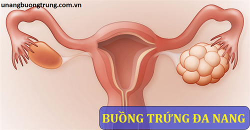 Buồng trứng đa nang là gì và ý nghĩa của hình ảnh buồng trứng đa nang trên siêu âm