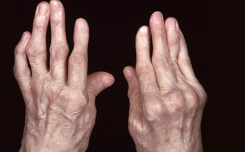 Bệnh viêm khớp dạng thấp có chữa khỏi được không? Làm cách nào để ngăn ngừa nguy cơ tàn phế?
