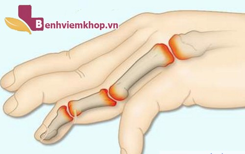 Bị đau khớp ngón tay áp út là dấu hiệu của bệnh gì?