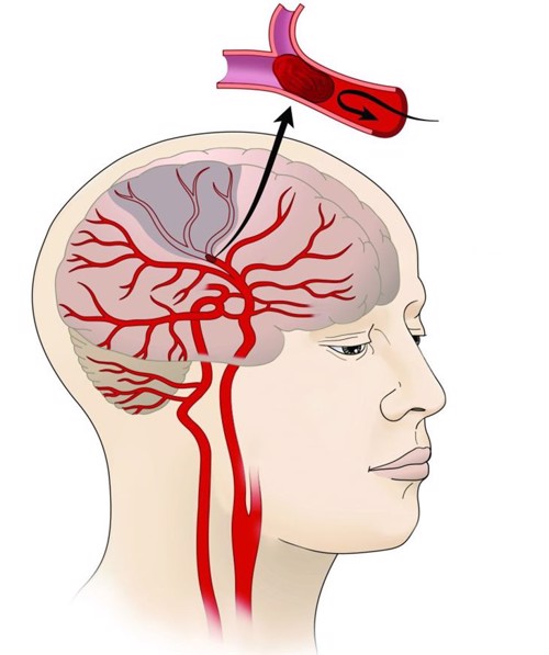 Làm sao để phòng ngừa đột quỵ hiệu quả?