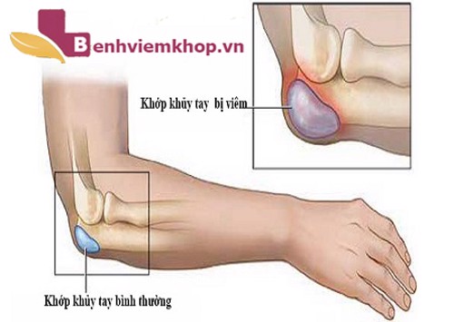 Tại sao người bị viêm khớp khuỷu tay nên dùng Hoàng Thấp Linh?
