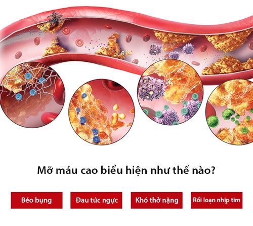 Dấu hiệu mỡ máu cao là gì? Chuyên gia Trần Quang Đạt tư vấn