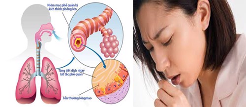 Ho khan kéo dài ở người lớn cảnh báo những căn bệnh hô hấp nguy hiểm nào? 