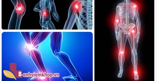 Top 5 bài thuốc chữa bệnh VIÊM ĐA KHỚP tại nhà đơn giản mà hiệu quả!