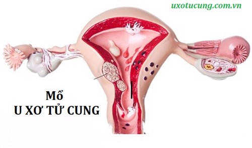 Mổ u xơ tử cung kiêng quan hệ bao lâu? - Có thể bạn chưa biết