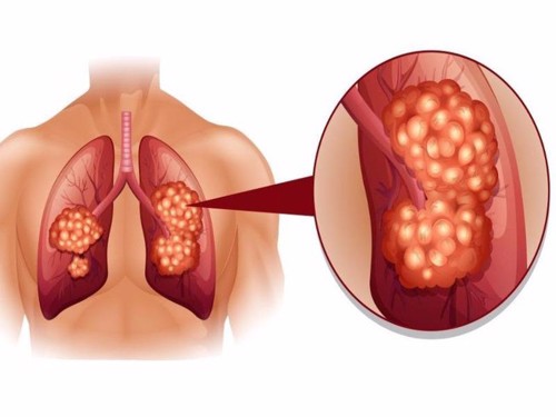 Bệnh viêm phế quản có thể gây ra những biến chứng như thế nào? TS Hoàng Văn Huấn tư vấn