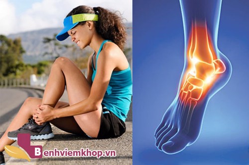 Tìm hiểu về bệnh VIÊM KHỚP CỔ CHÂN và các phương pháp điều trị hiện nay