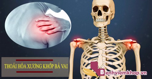 Tổng quan về bệnh thoái hóa xương khớp và những thông tin hữu ích dành cho bạn