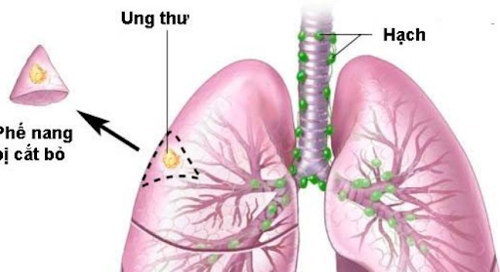 Ho có đờm vàng là biểu hiện thường gặp của các căn bệnh hô hấp nào?