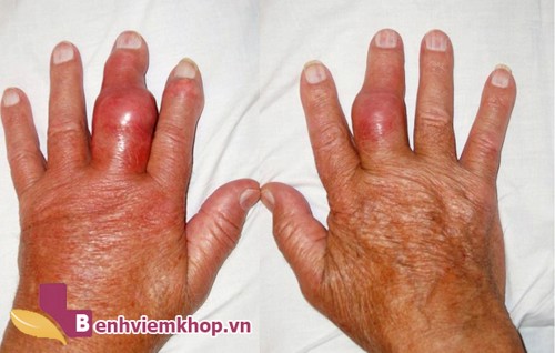 Ngón tay bị sưng đỏ đau nhức là dấu hiệu của bệnh gì? Xem ngay để biết!