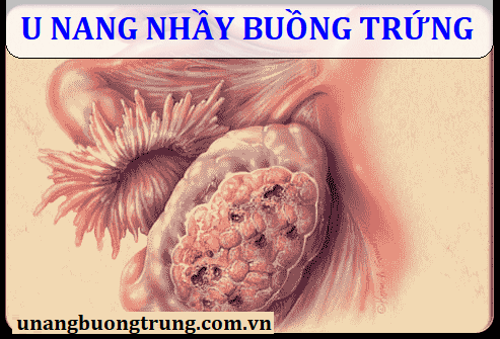 U nang nhầy buồng trứng là gì và có nguy hiểm không? – ĐỌC NGAY để biết tường tận!