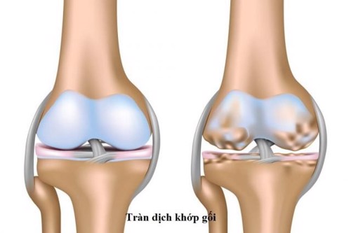 Tràn dịch khớp gối là gì? Thường gặp ở những đối tượng nào? PGS. TS Vũ Thị Thanh Thủy giải đáp