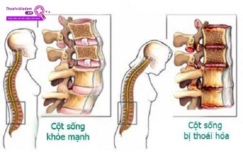 Đau lưng, đứng lên, ngồi xuống khó khăn do thoái hóa cột sống thắt lưng, phải làm sao? 