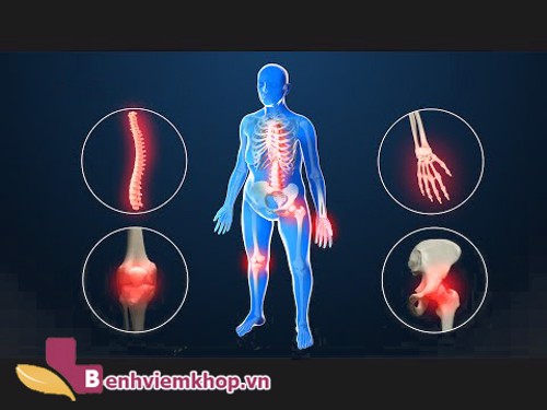 3 cách chữa VIÊM ĐA KHỚP bằng thuốc nam đơn giản tại nhà