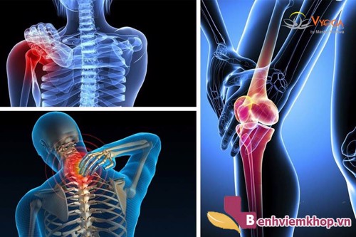 Người bị KHÔ KHỚP ăn gì thì tốt? NOTE ngay 10 thực phẩm hữu ích sau đây!