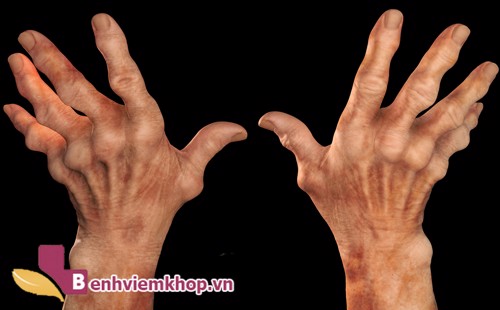 Phương pháp điều trị VIÊM KHỚP DẠNG THẤP bằng thuốc đông y có những ưu – nhược điểm gì?
