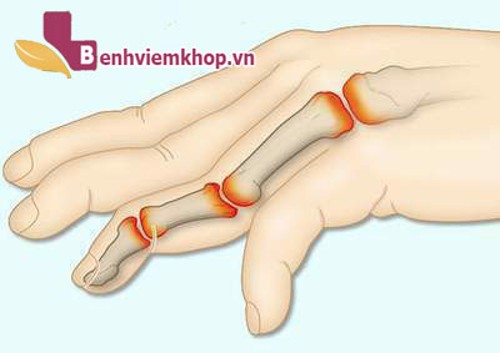 Bị ĐAU NHỨC CÁC ĐỐT NGÓN TAY là dấu hiệu của bệnh gì?