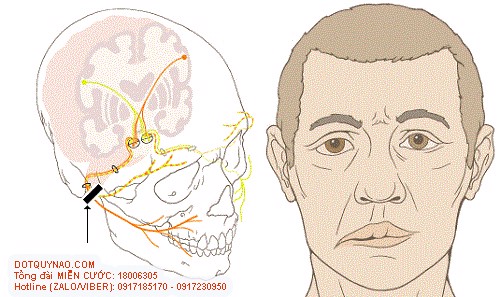 Chữa liệt dây thần kinh số 7 sau tai biến mạch máu não như thế nào?