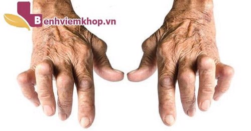 Bị viêm đa khớp dạng thấp nên ăn gì? Click, xem ngay!