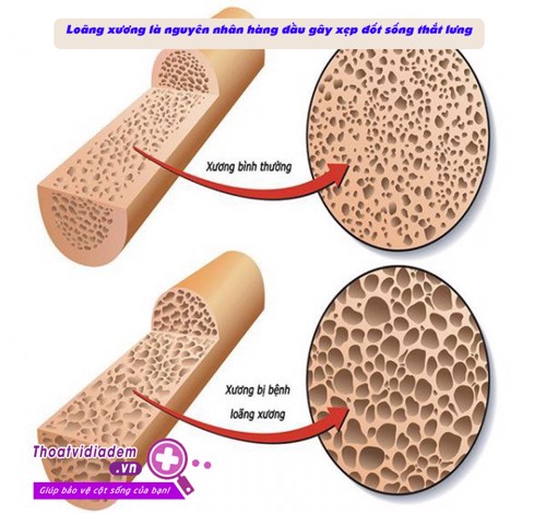 Biến chứng nguy hiểm do xẹp đốt sống lưng là gì? 