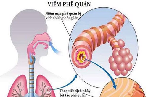 Bị viêm phế quản mạn tính dùng Bảo Phế Vương hỗ trợ điều trị lâu dài có ảnh hưởng gì không?