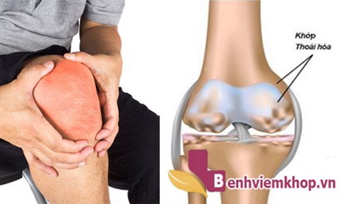 Người bị THOÁI HÓA KHỚP GỐI có nên đi bộ không?