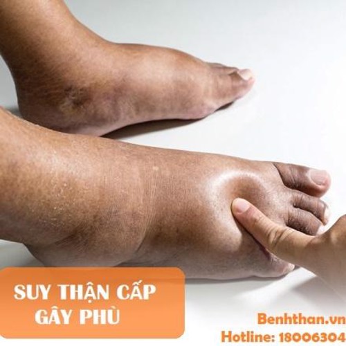 5 dấu hiệu suy thận cấp điển hình không thể bỏ qua