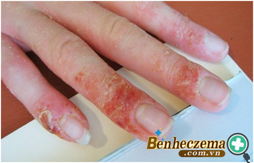 Cải thiện bệnh chàm khô đầu ngón tay hiệu quả bằng kem bôi Eczestop