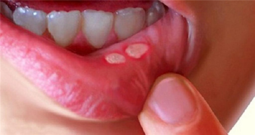 Viêm loét niêm mạc miệng: Nguyên nhân, triệu chứng và cách điều trị bệnh an toàn, hiệu quả