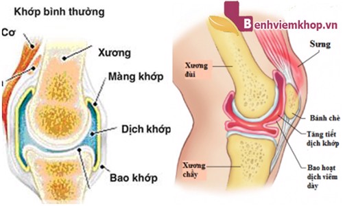 Viêm bao hoạt dịch khớp gối là bệnh gì? Nguyên nhân và cách điều trị